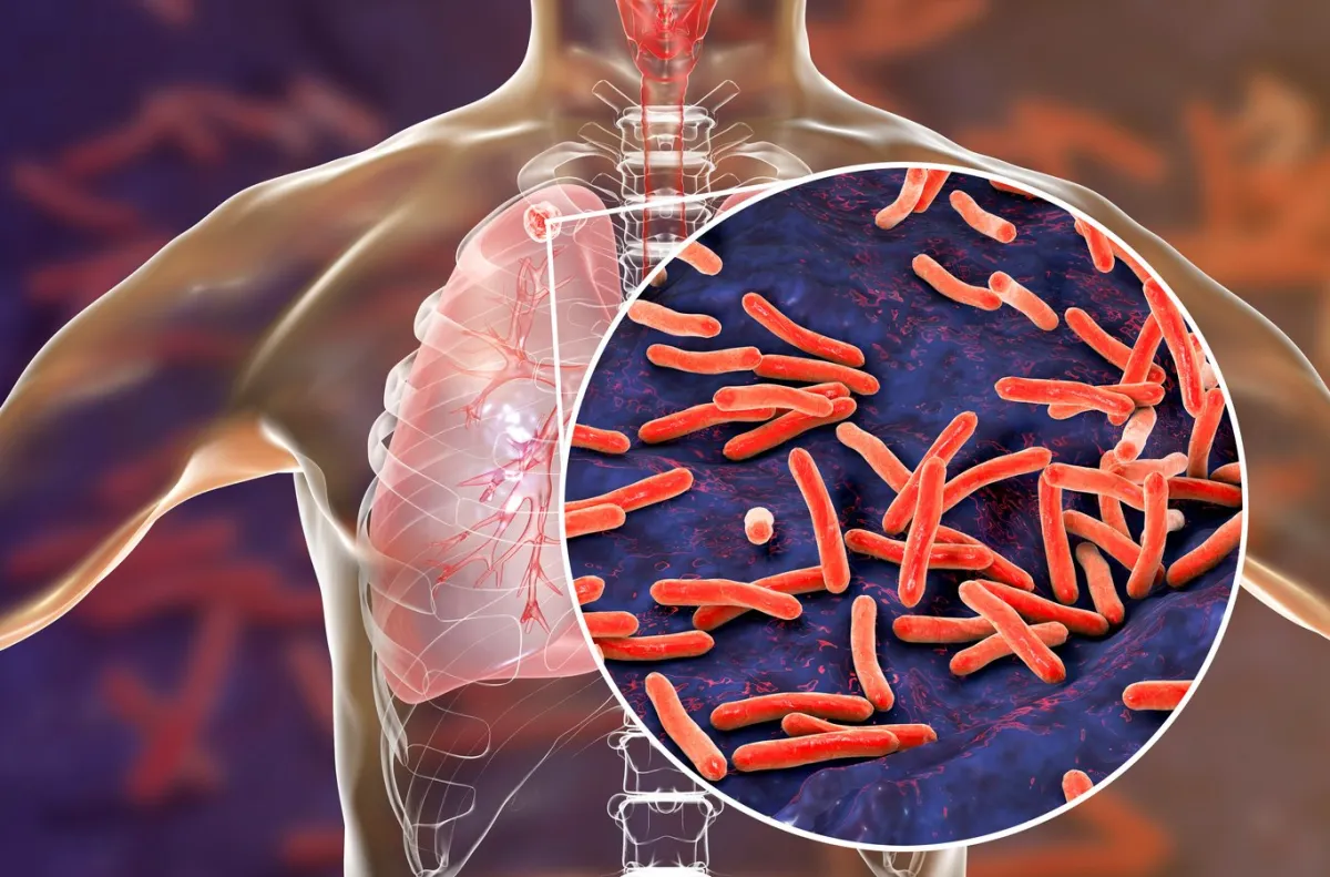 Tos persistente: alerta por tuberculosis en México