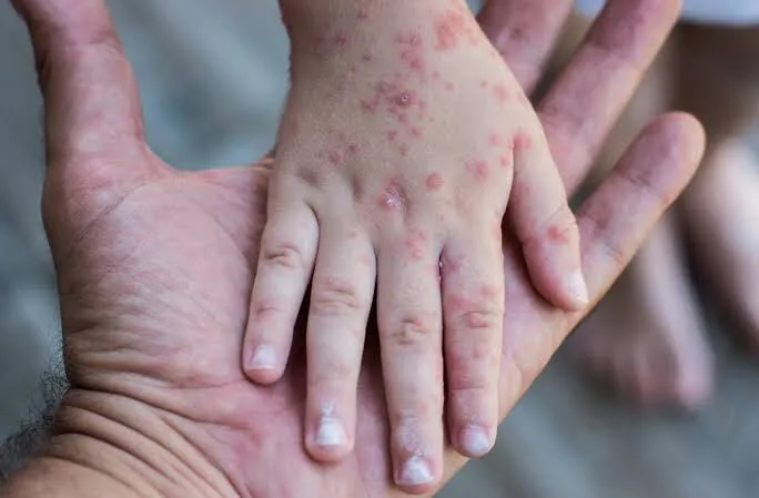 SSA emite aviso epidemiológico por sarampión; casos se triplican en 2025