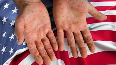 Estados Unidos recomienda vacunación contra el sarampión a todos los viajeros internacionales, sin excepción